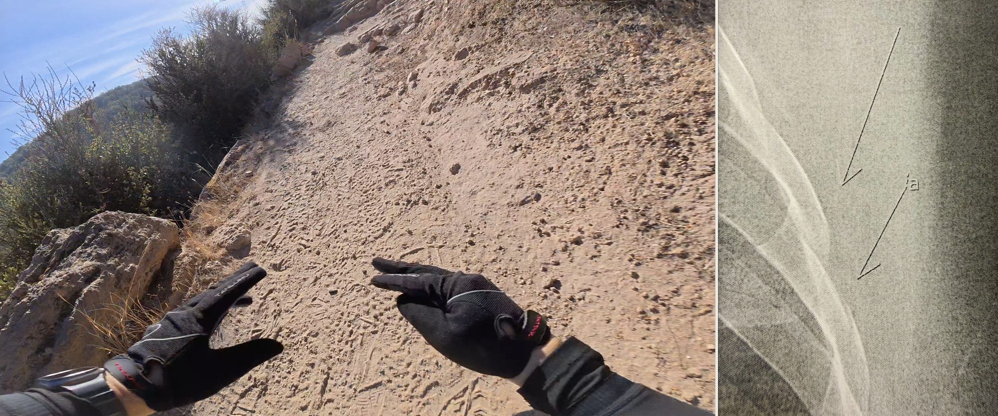 POV of a mountain bike trail with hands off the grips, next to an X-ray